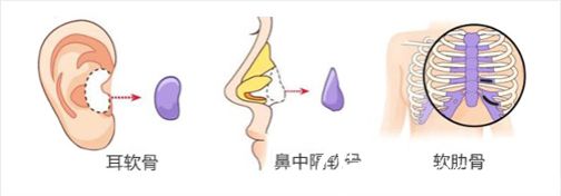 自體軟骨隆鼻材料