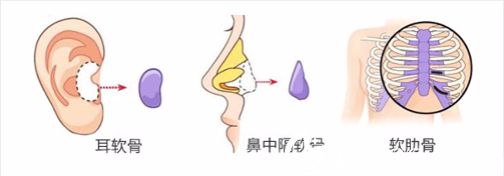 自體軟骨隆鼻