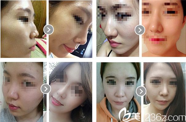 韓國will醫(yī)院怎么讓鼻子變小變挺