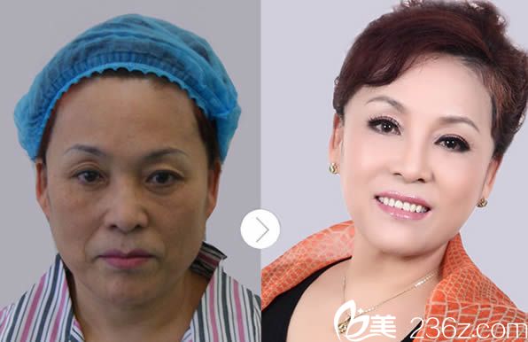 韓國5D提拉術前后對比案例