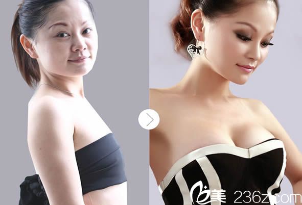  韓國內窺鏡隆胸對比效果圖