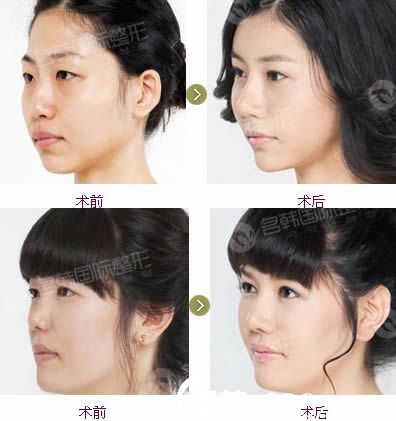 卓敬錫假體隆鼻案例圖 卓敬錫假體隆鼻案例圖