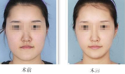 瘦臉真人案例 瘦臉真人案例