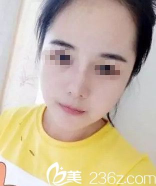 在沈陽(yáng)名流做隆鼻手術(shù)后10天 在沈陽(yáng)名流做隆鼻手術(shù)后10天