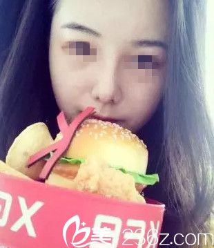 在沈陽(yáng)名流做隆鼻手術(shù)后1個(gè)月 在沈陽(yáng)名流做隆鼻手術(shù)后1個(gè)月