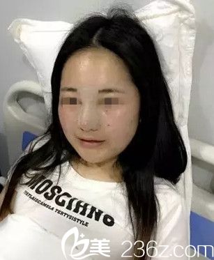 在沈陽(yáng)名流做隆鼻手術(shù)當(dāng)天 在沈陽(yáng)名流做隆鼻手術(shù)當(dāng)天