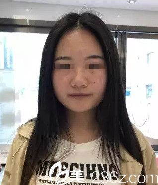 在沈陽(yáng)名流做隆鼻手術(shù)前 在沈陽(yáng)名流做隆鼻手術(shù)前