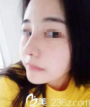 在沈陽(yáng)名流做隆鼻手術(shù)后一周 在沈陽(yáng)名流做隆鼻手術(shù)后一周