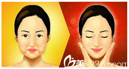 北京米蘭柏羽麗都整形美容醫(yī)院嘴角下垂圖