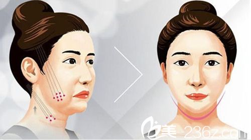 沈陽名流PPDO多維線雕提升術(shù) 沈陽名流PPDO多維線雕提升術(shù)