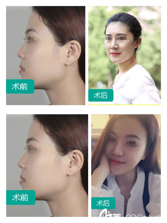 石家莊雅芳亞鼻綜合整形案例 石家莊雅芳亞鼻綜合整形案例