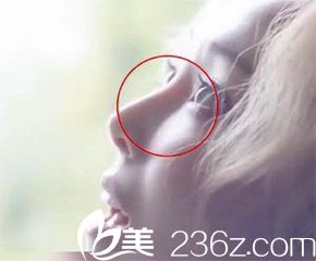 硅膠假體隆鼻鼻部出現(xiàn)透光