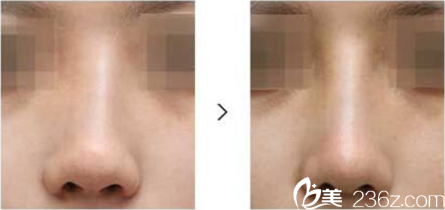 隆鼻后遺癥假體移位不穩(wěn)定