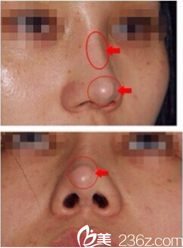 隆鼻后遺癥假體外露