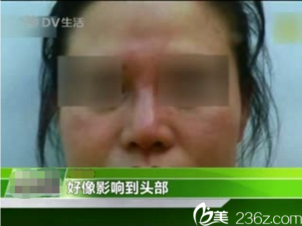 隆鼻后遺癥假體排斥紅腫