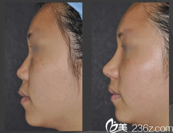 韓國will醫(yī)院假體隆鼻真人案例