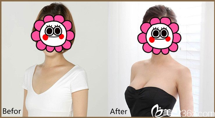 彭義坤醫(yī)生隆胸案例