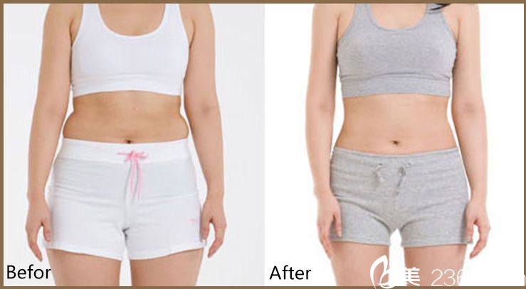 彭義坤醫(yī)生吸脂案例