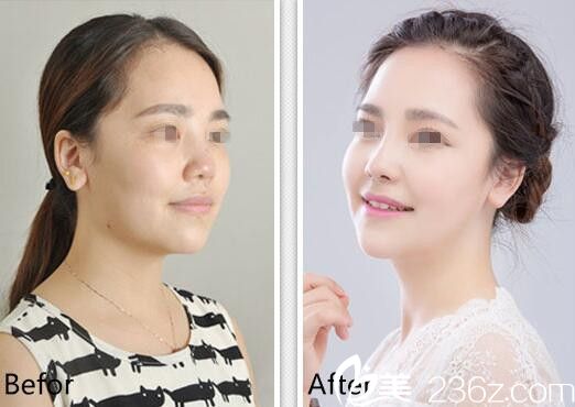 包濤隆鼻前后對比案例 包濤隆鼻前后對比案例