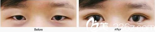 洪政槿雙眼皮整形案例 洪政槿雙眼皮整形案例