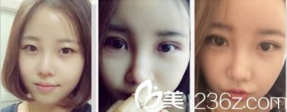 洪政槿雙眼皮案例圖 洪政槿雙眼皮案例圖