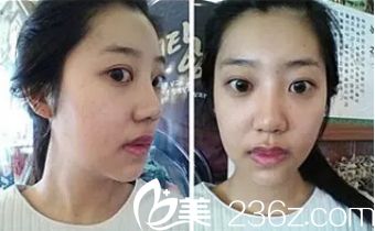 北京米蘭柏羽麗都醫(yī)院微笑唇真人術(shù)前圖片