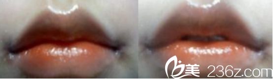 做嘴角上揚(yáng)哪家醫(yī)院好？北京米蘭柏羽麗都醫(yī)院微笑唇真人分享術(shù)后兩周的樣子