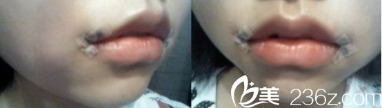 北京米蘭柏羽麗都醫(yī)院微笑唇真人手術(shù)剛結(jié)束的時(shí)候