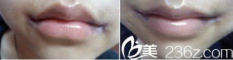 做嘴角上揚(yáng)哪家醫(yī)院好？北京米蘭柏羽麗都醫(yī)院微笑唇真人拆線后的樣子