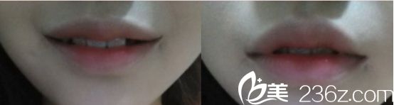 做嘴角上揚(yáng)哪家醫(yī)院好？北京米蘭柏羽麗都醫(yī)院微笑唇真人分享術(shù)后三個(gè)月的樣子