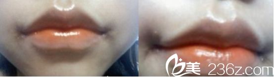 做嘴角上揚(yáng)哪家醫(yī)院好？北京米蘭柏羽麗都醫(yī)院微笑唇真人分享術(shù)后一個(gè)月的樣子