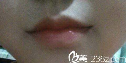 做嘴角上揚(yáng)哪家醫(yī)院好？北京米蘭柏羽麗都醫(yī)院微笑唇真人術(shù)后好的樣子