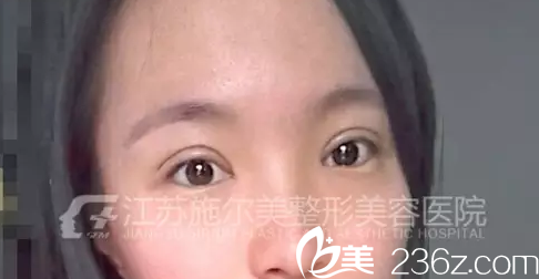 術(shù)后第六天雙眼皮加開(kāi)眼角還在恢復(fù)中 術(shù)后第六天雙眼皮加開(kāi)眼角還在恢復(fù)中