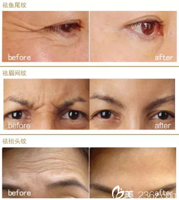 伊麗莎白整形蘇炳云面部年輕化<span style= 伊麗莎白整形蘇炳云面部年輕化<span style=