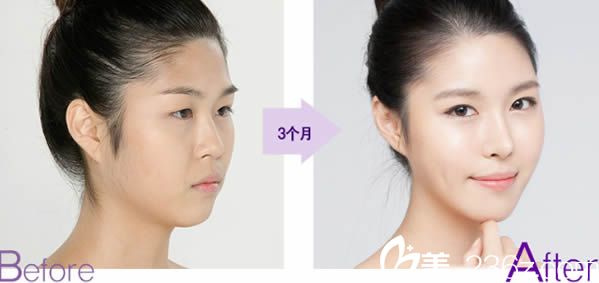 韓國李益準自體脂肪填充案例圖
