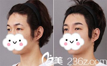 韓式三點雙眼皮前后對比案例 韓式三點雙眼皮前后對比案例