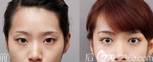 李益準雙眼皮前后對比效果