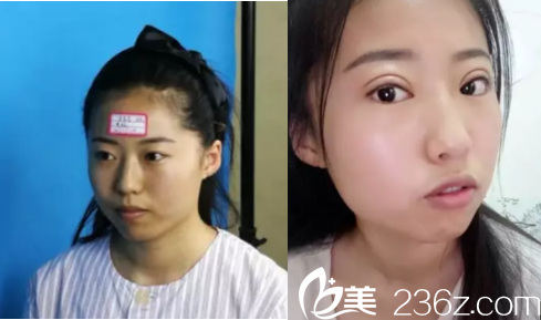 伊麗莎白整形何山雙眼皮案例 伊麗莎白整形何山雙眼皮案例