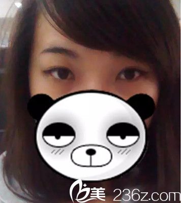 術(shù)前是內(nèi)雙 術(shù)前是內(nèi)雙