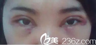 做完手術(shù)第2天眼睛腫脹 做完手術(shù)第2天眼睛腫脹
