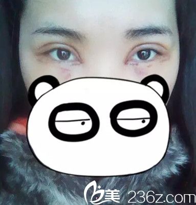 當天下午眼睛消腫了不少 當天下午眼睛消腫了不少