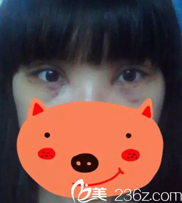 術(shù)后4天眼睛繼續(xù)恢復(fù)中 術(shù)后4天眼睛繼續(xù)恢復(fù)中