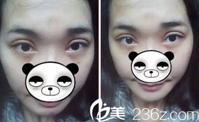 術(shù)后7天拆線眼睛的樣子 術(shù)后7天拆線眼睛的樣子