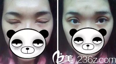 拆線后第4天眼睛睜閉狀態(tài) 拆線后第4天眼睛睜閉狀態(tài)