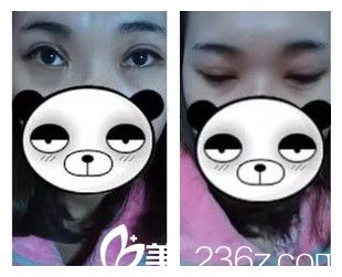 術(shù)后15天還在恢復(fù)中 術(shù)后15天還在恢復(fù)中