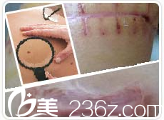 張家龍祛疤分型診治