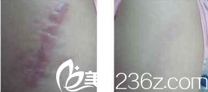 運用美學理念祛疤