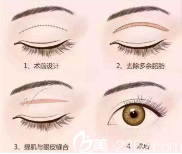北京米蘭柏羽麗都整形醫(yī)院切開(kāi)雙眼皮示意圖