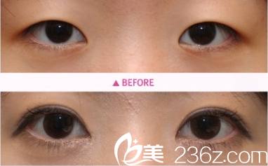 北京米蘭柏羽麗都整形醫(yī)院案例