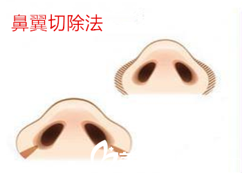鼻翼整形方法之一鼻翼切除法
